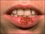 Herpesul bucal